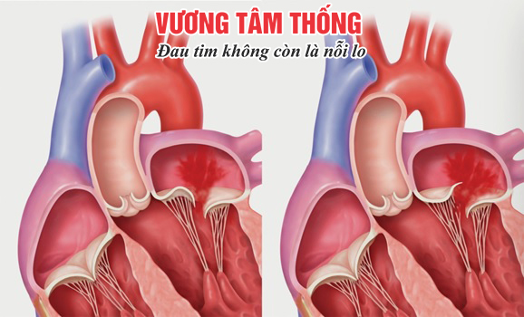 Hình ảnh máu bị trào ngược do hở van tim.jpg